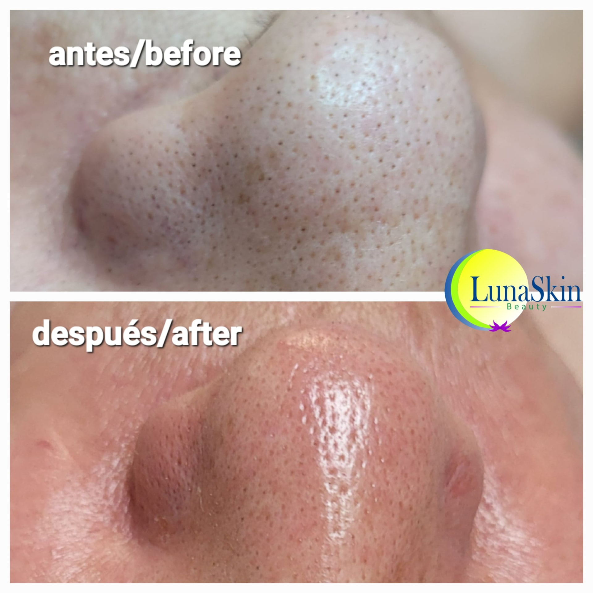 Antes y después: limpieza profunda de poros
