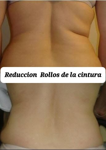 Reducción de rollos de la cintura