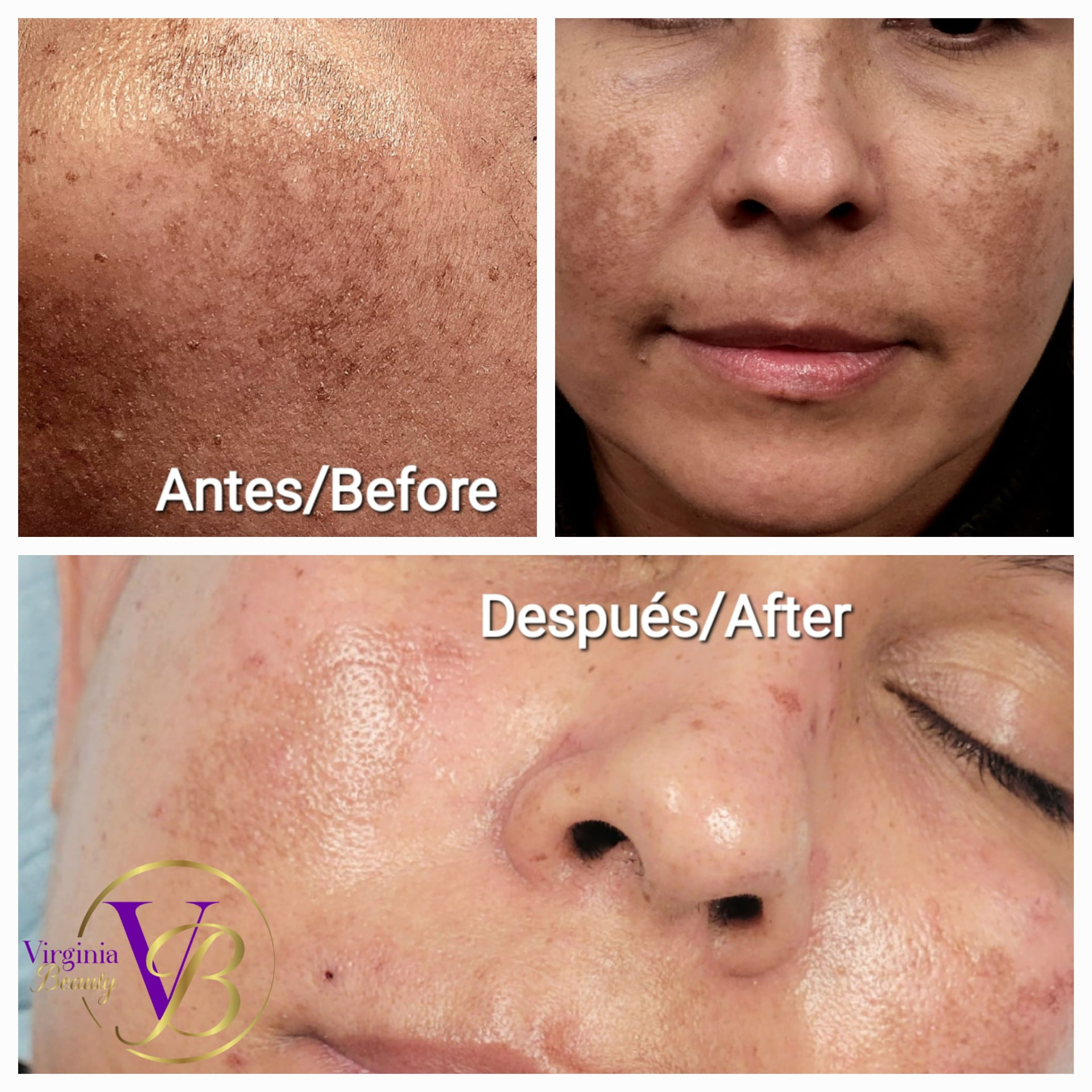 Antes y después: manchas y melasma facial