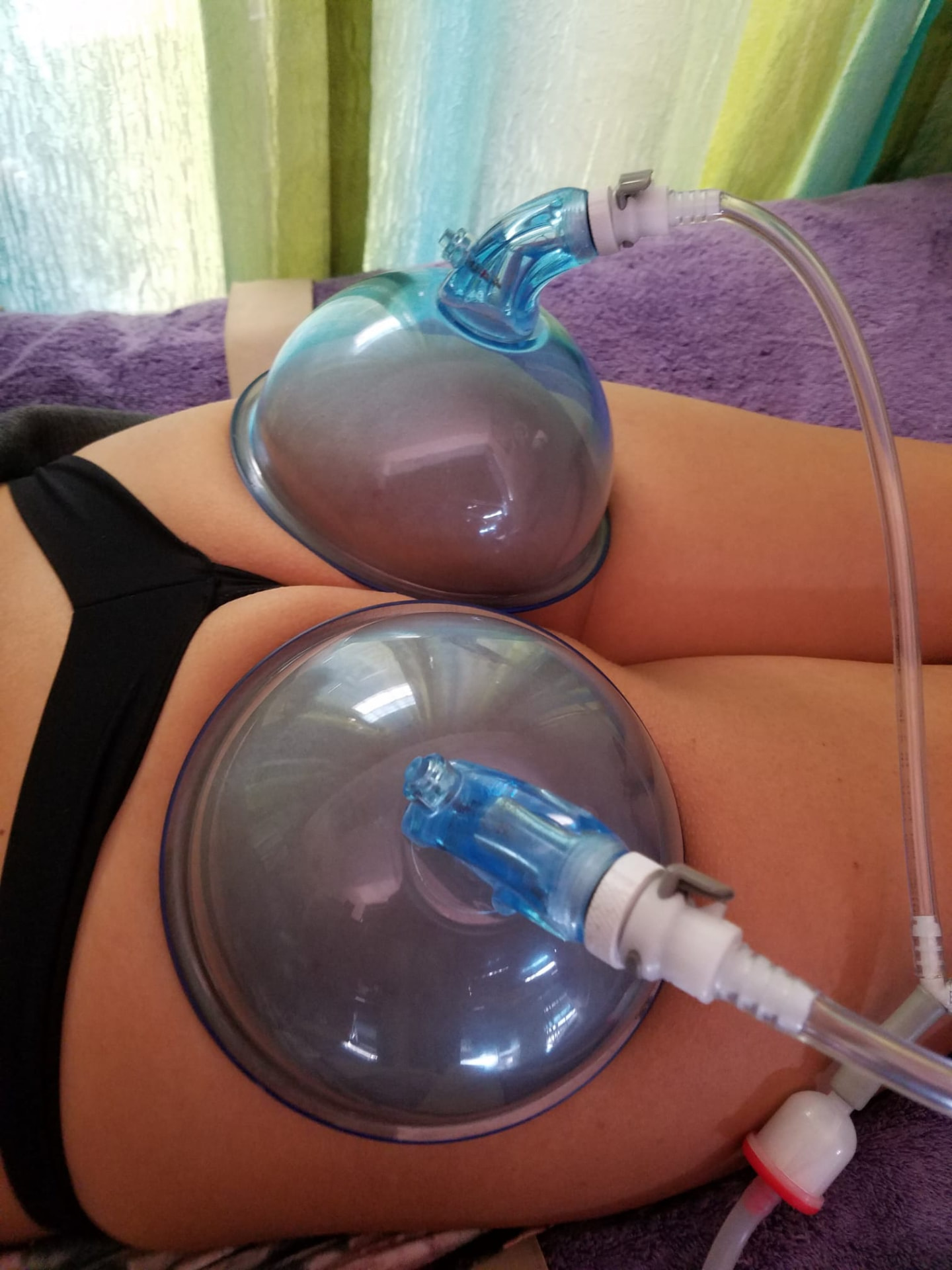 Vacumterapia para levantamiento de glúteos
