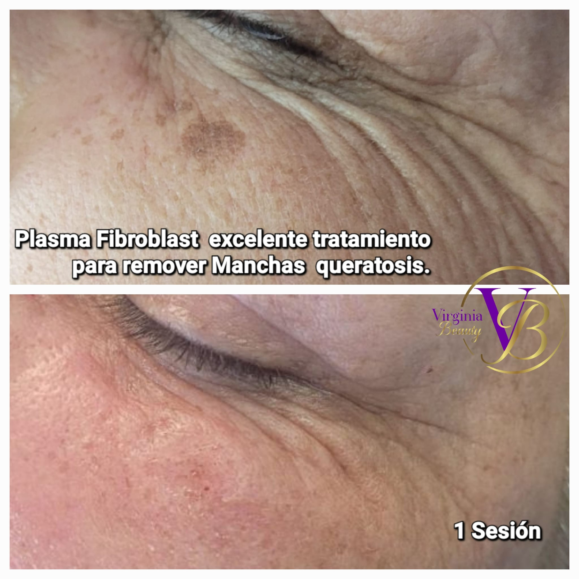 Plasma Fibroblast: remoción de manchas de queratosis