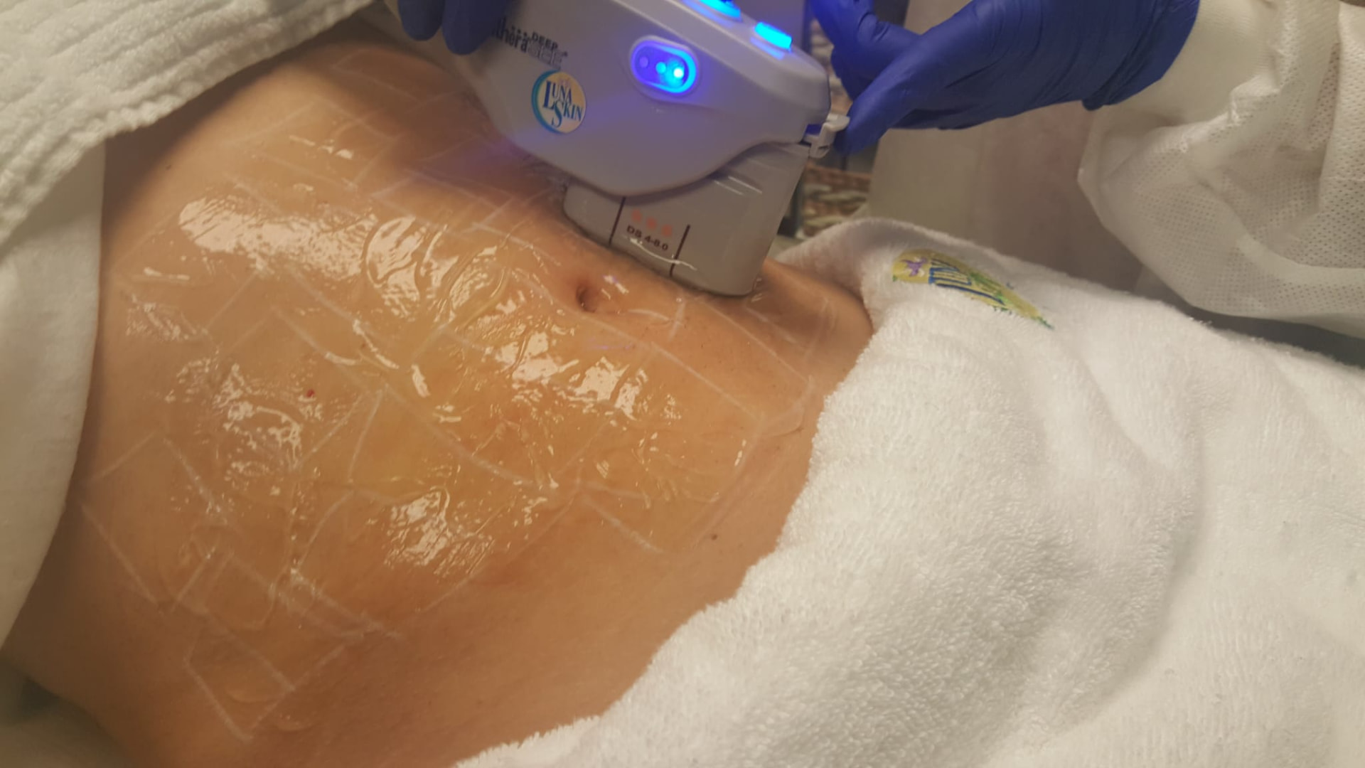 Cavitación ultrasónica en abdomen