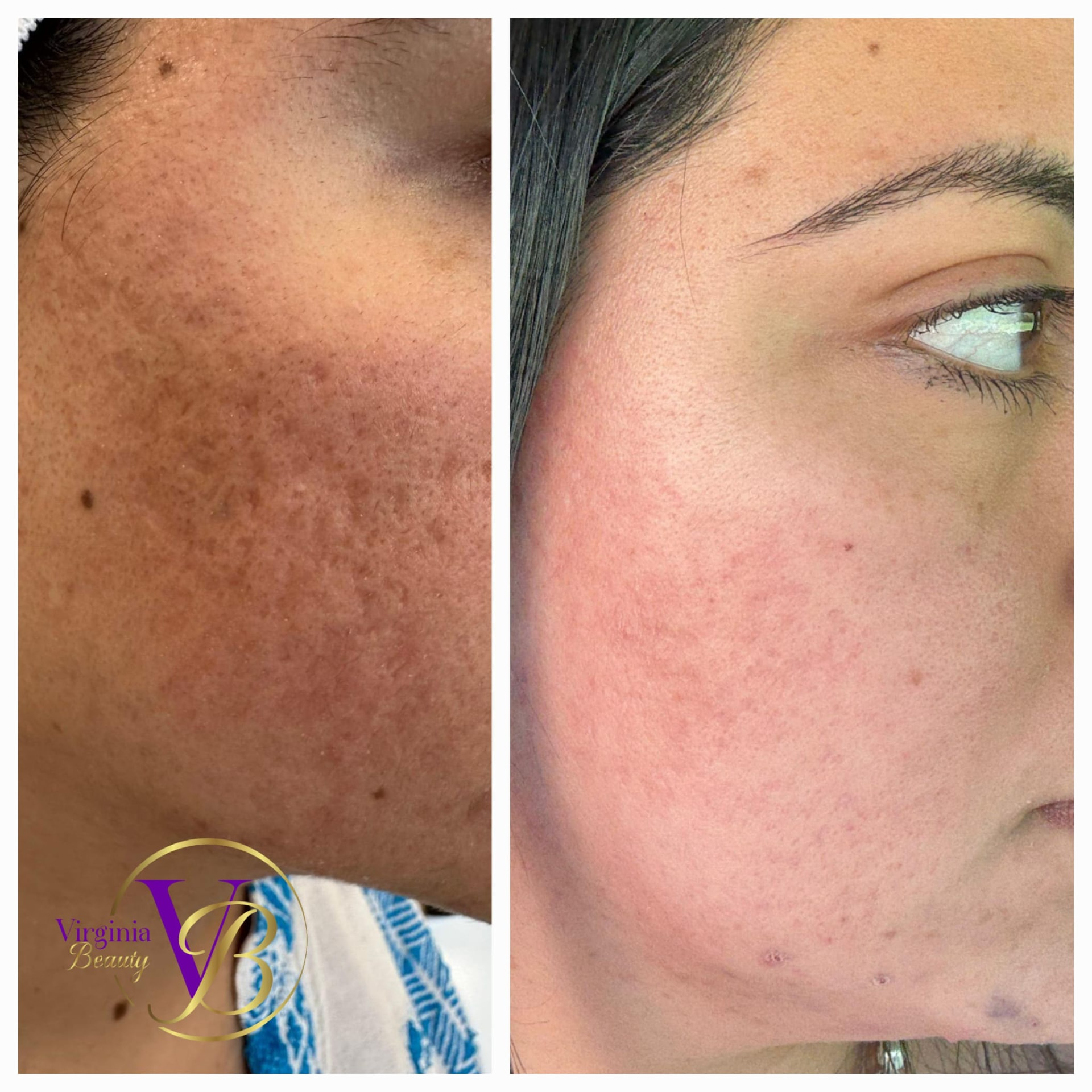 Antes y después: manchas y textura de la piel del rostro